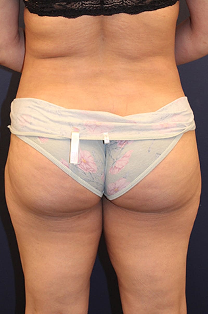 Brazilian Butt Lift Before & After