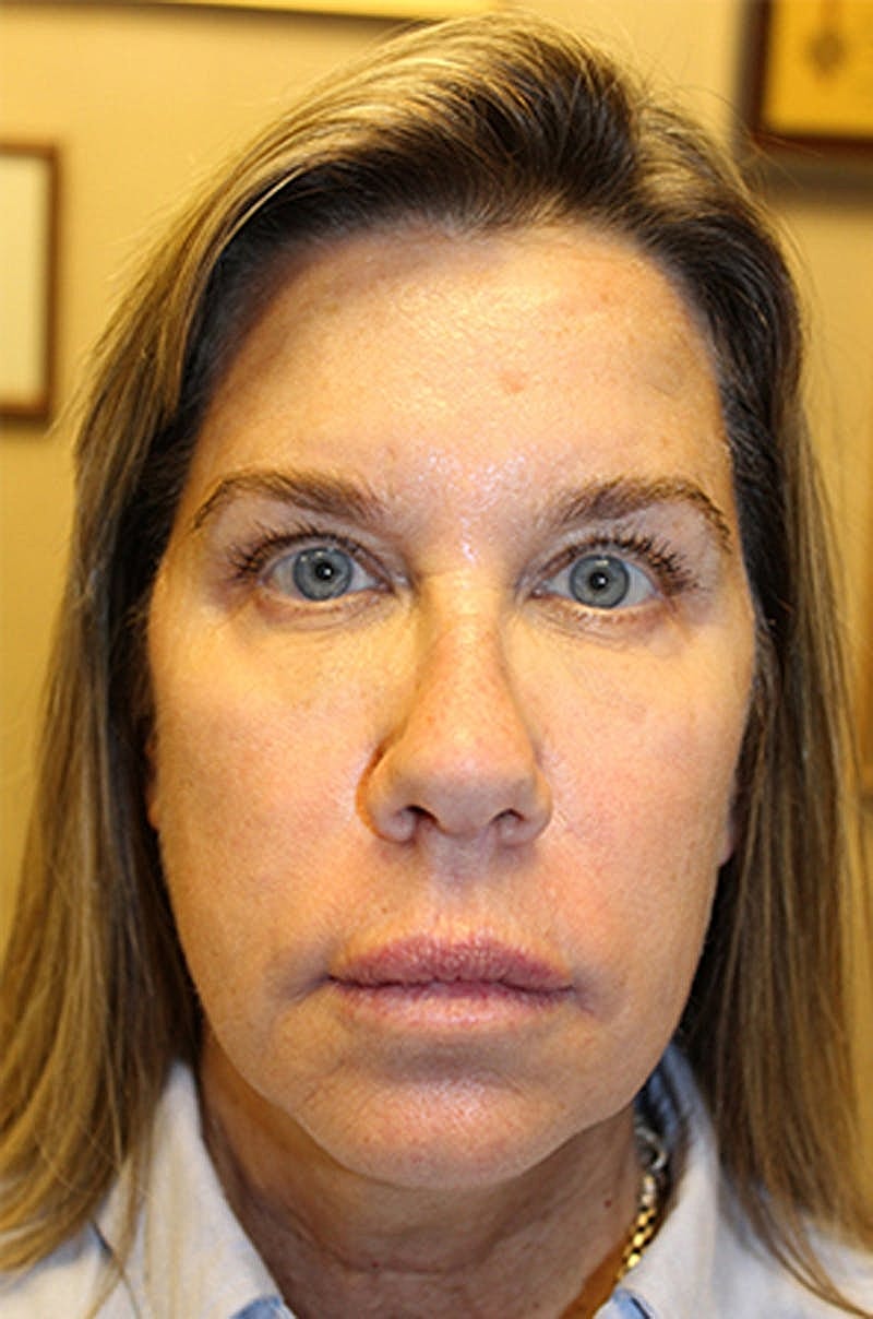 Jeauveau Before & After