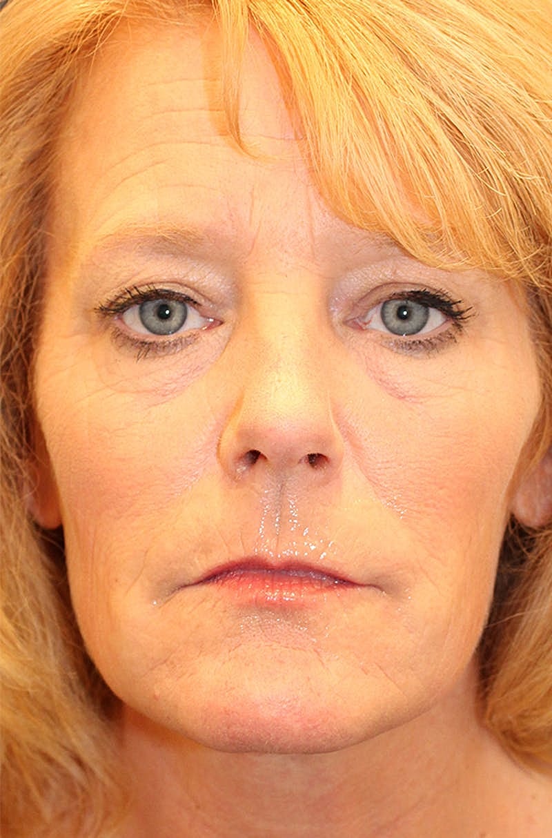 Jeauveau Before & After