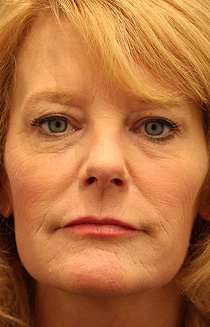 Jeauveau Before & After