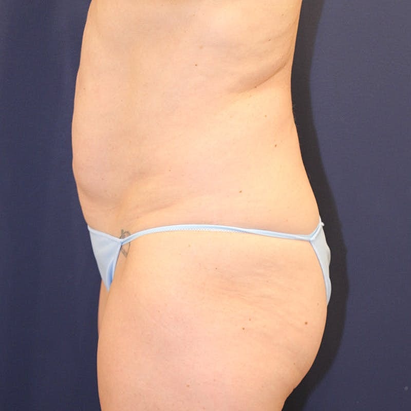 Tummy Tuck Before & After