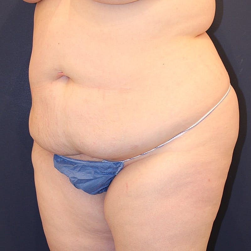 Tummy Tuck Before & After