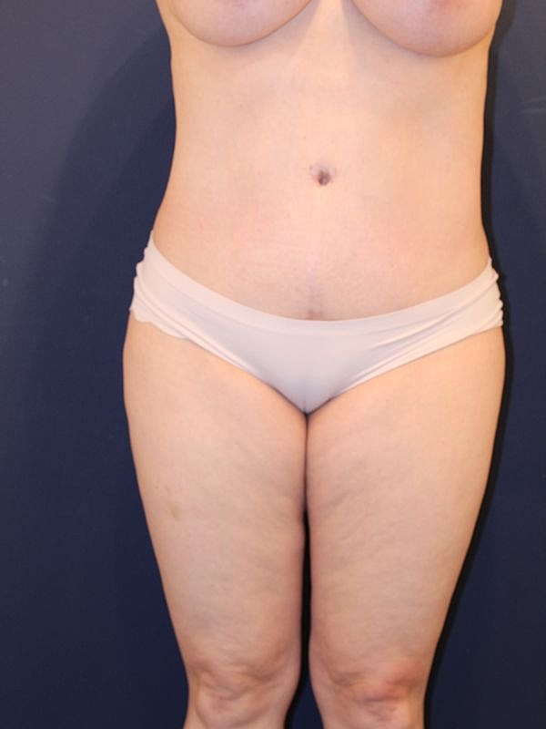 Tummy Tuck Gallery Before & After