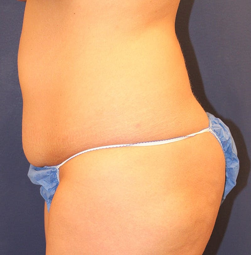 Tummy Tuck Before & After