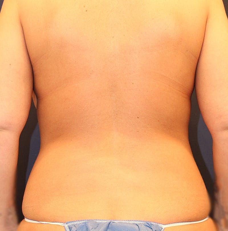 Tummy Tuck Before & After