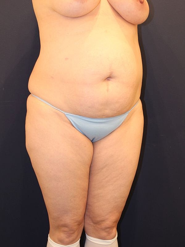 Tummy Tuck Gallery Before & After