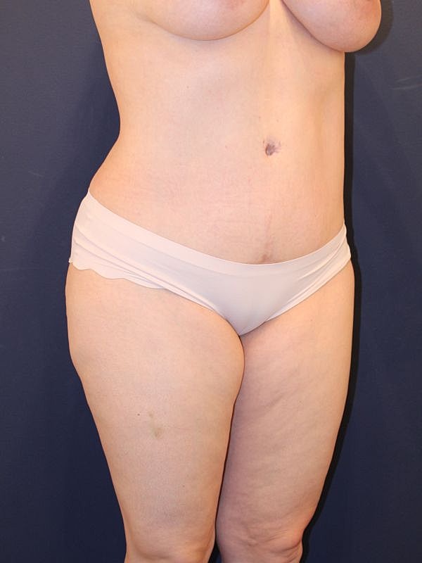 Tummy Tuck Gallery Before & After