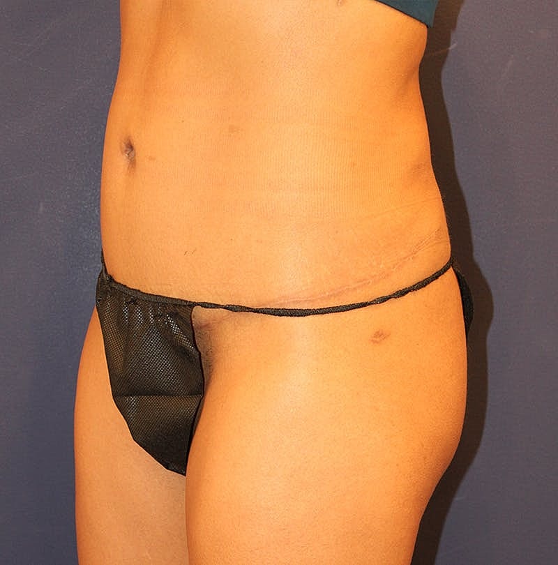 Tummy Tuck Before & After