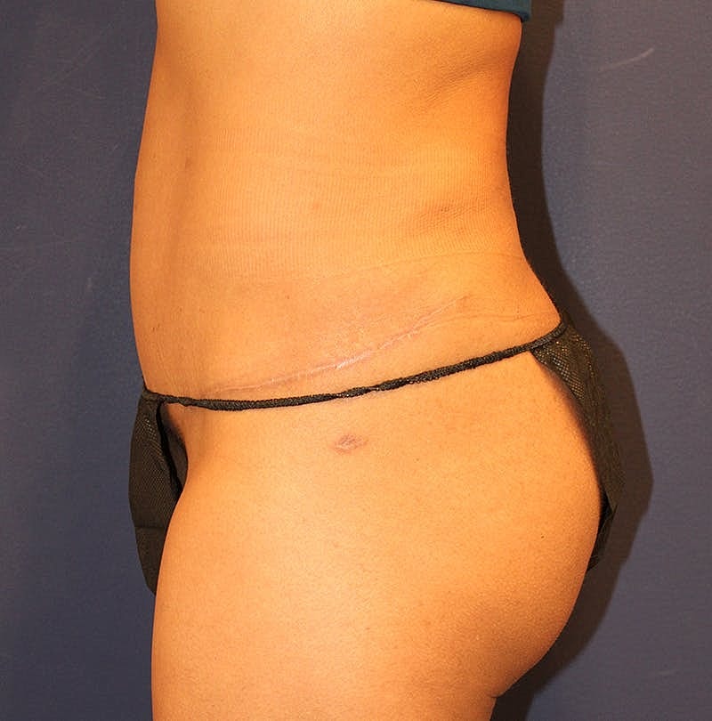 Tummy Tuck Before & After