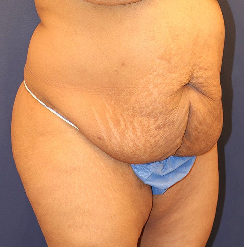 Tummy Tuck Before & After