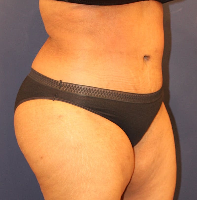 Tummy Tuck Before & After