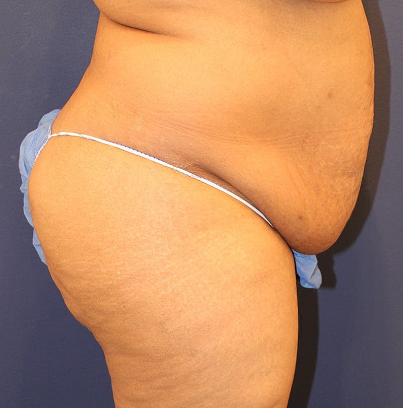 Tummy Tuck Before & After