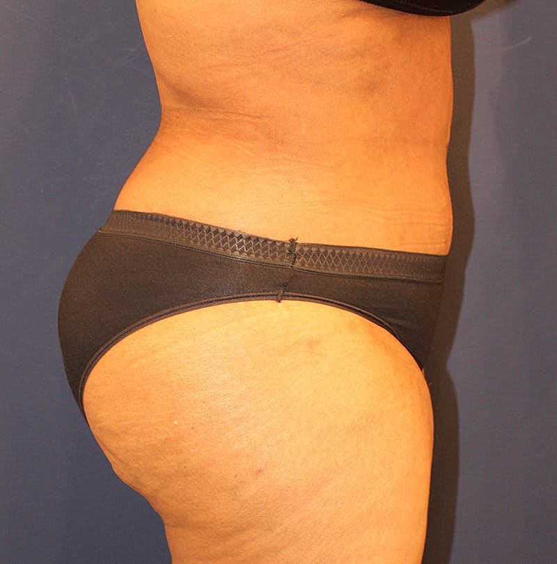 Tummy Tuck Before & After