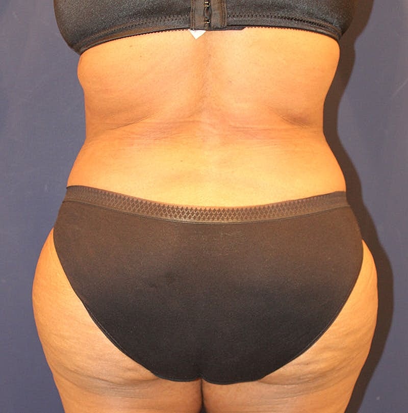 Tummy Tuck Before & After