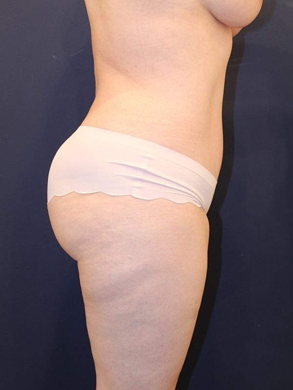Tummy Tuck Gallery Before & After