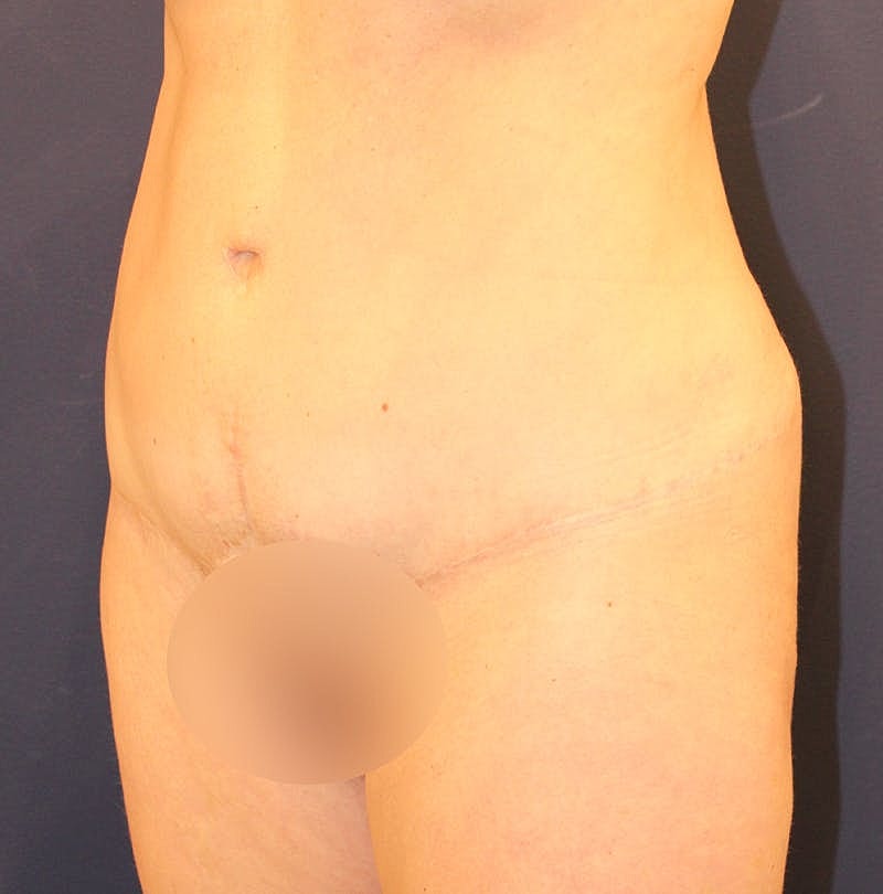 Tummy Tuck Before & After