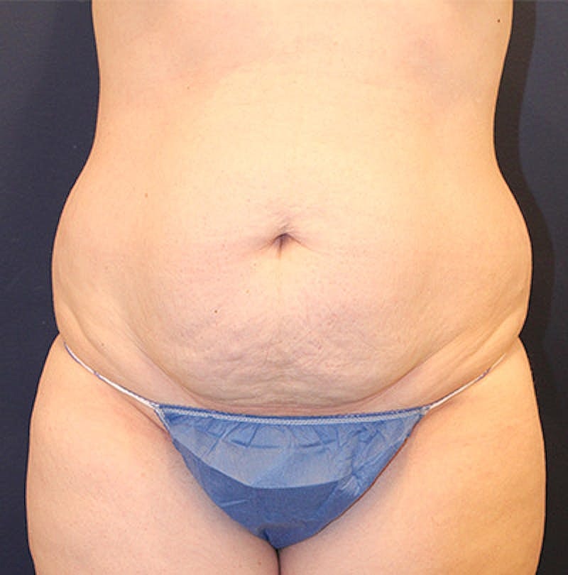 Tummy Tuck Before & After