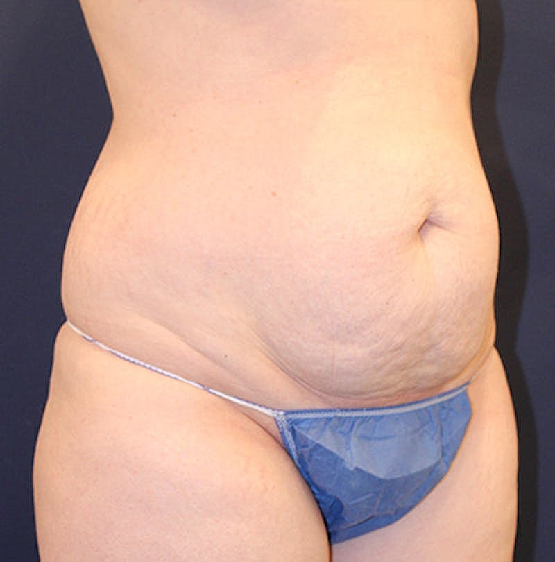 Tummy Tuck Before & After