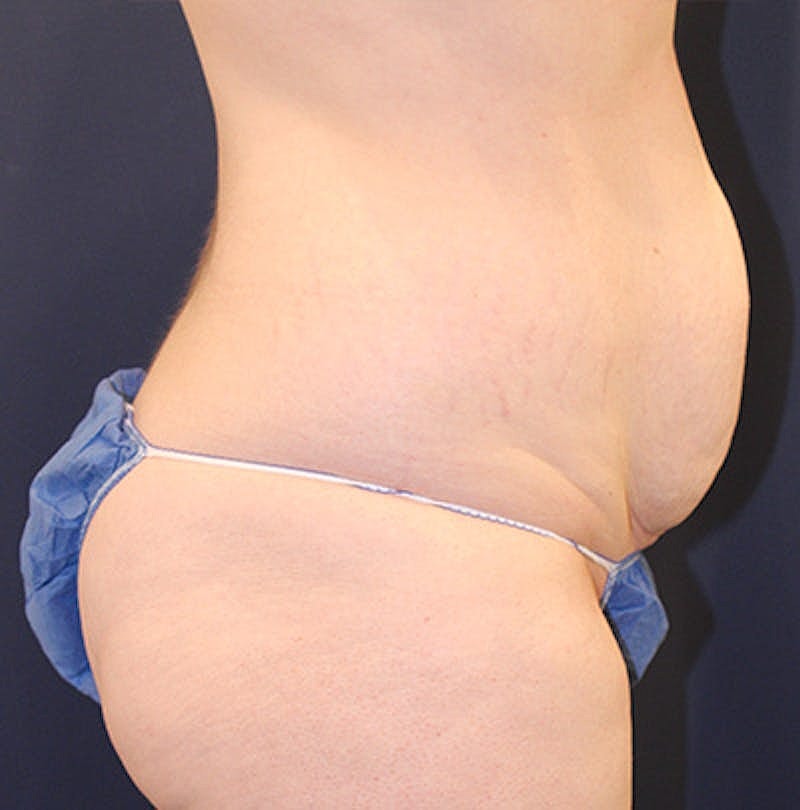 Tummy Tuck Before & After