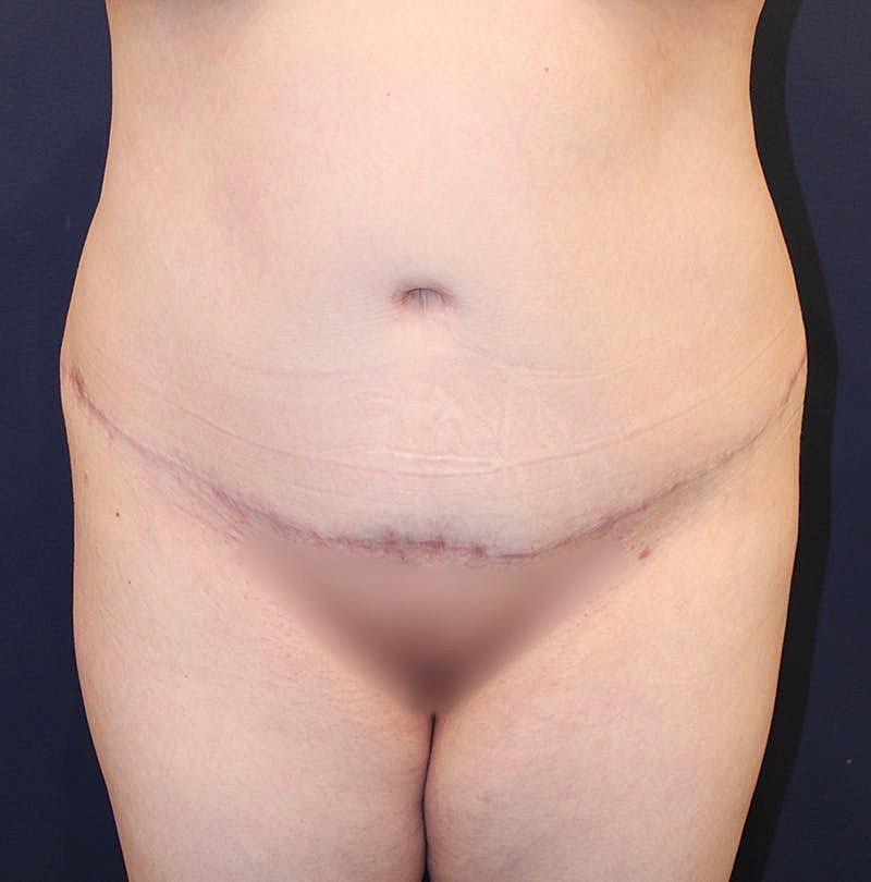 Tummy Tuck Before & After