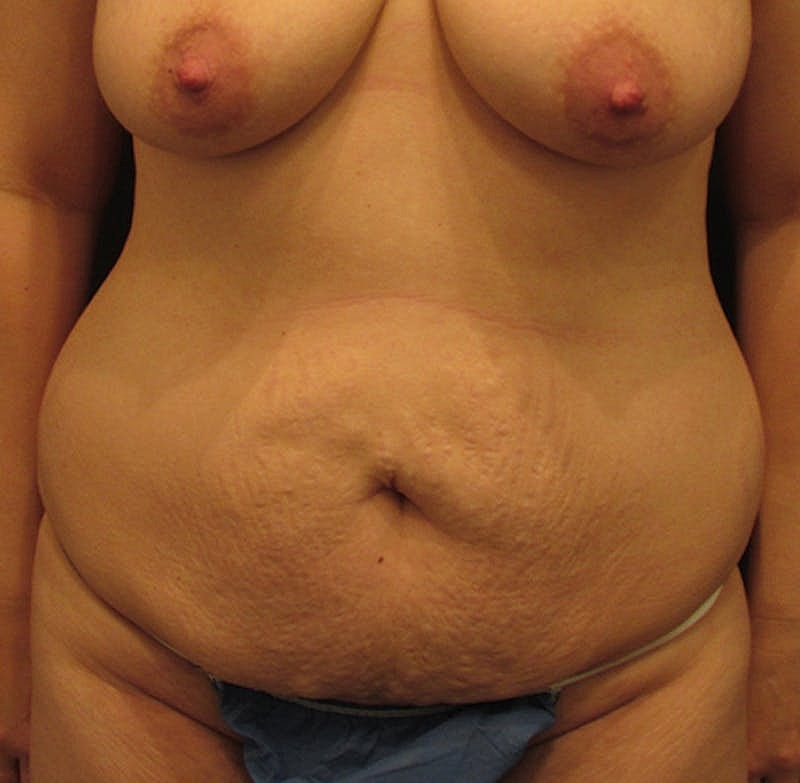 Tummy Tuck Before & After