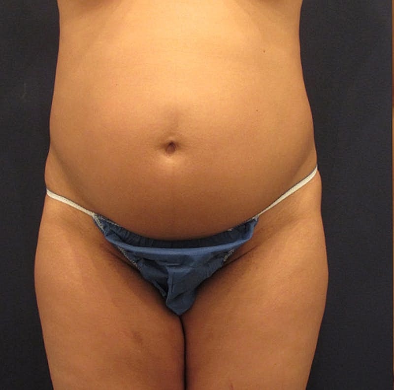 Tummy Tuck Before & After