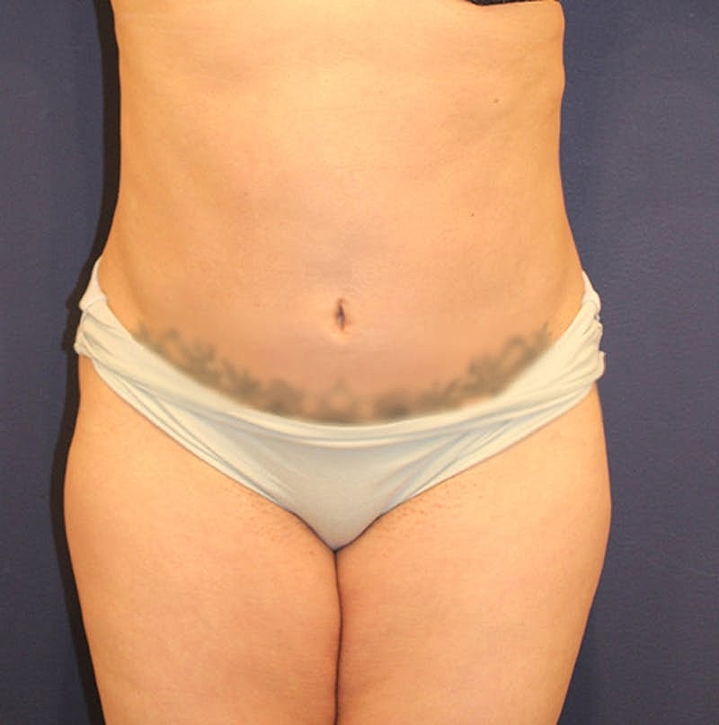 Tummy Tuck Before & After
