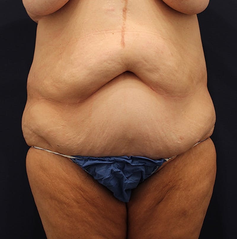 Tummy Tuck Before & After