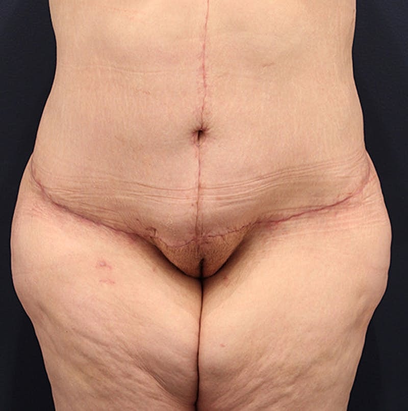 Tummy Tuck Before & After