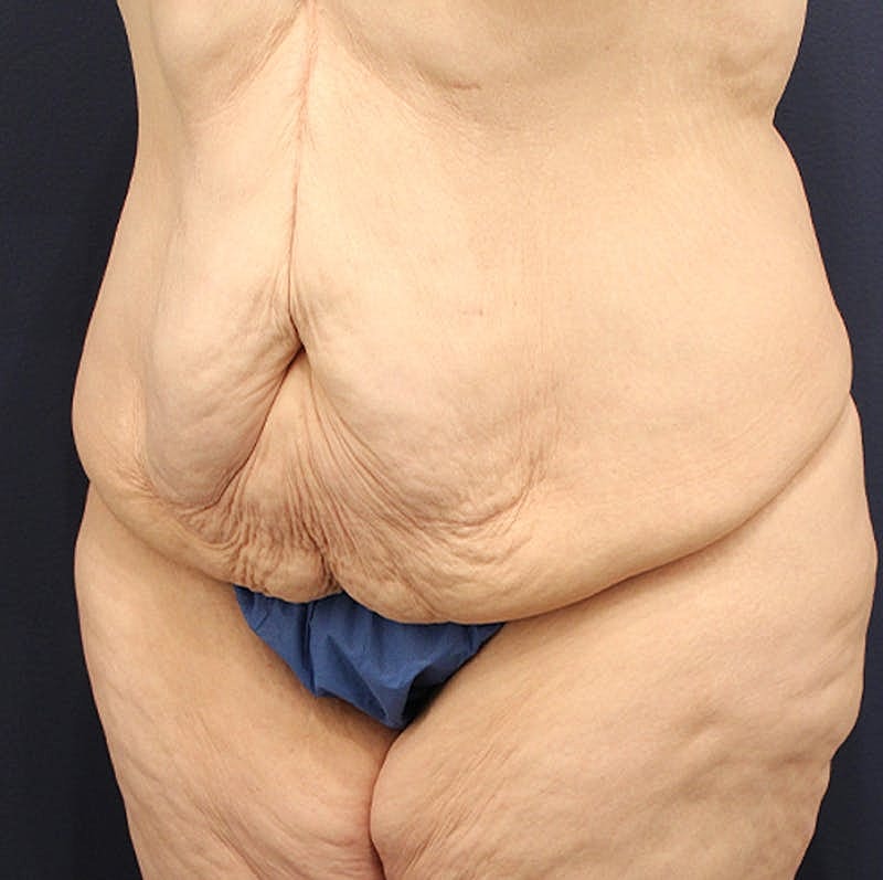 Tummy Tuck Before & After