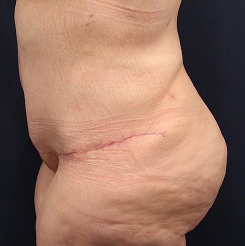 Tummy Tuck Before & After