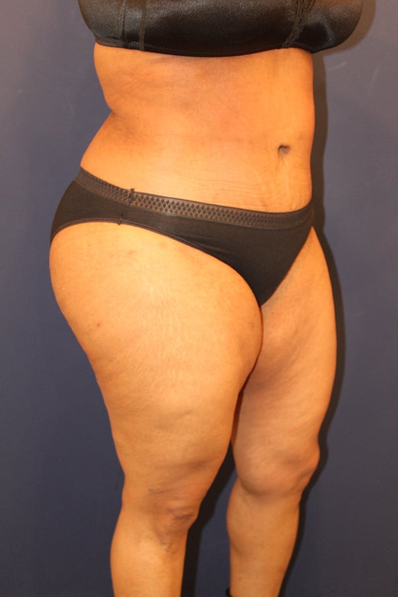 Tummy Tuck Before & After