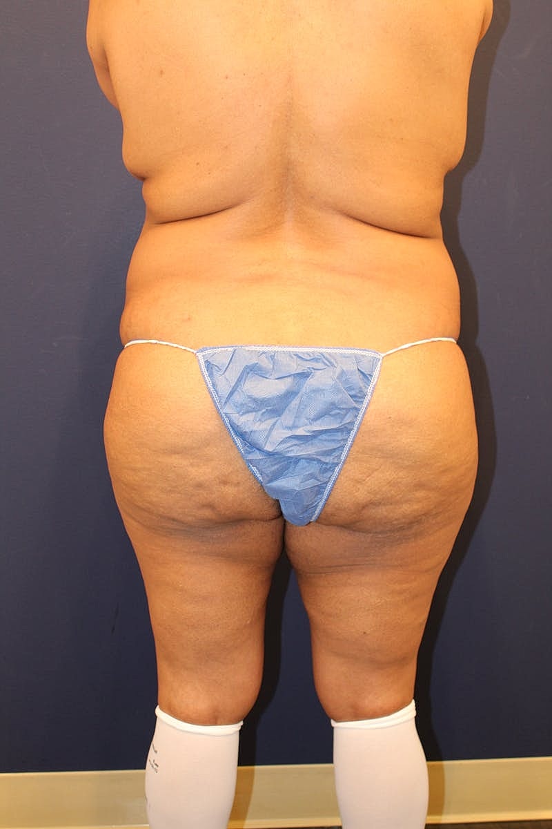 Tummy Tuck Before & After