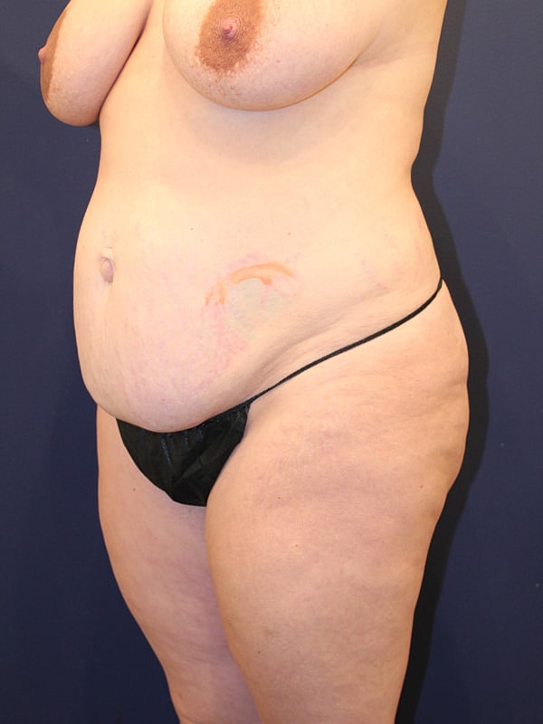 Tummy Tuck Gallery Before & After