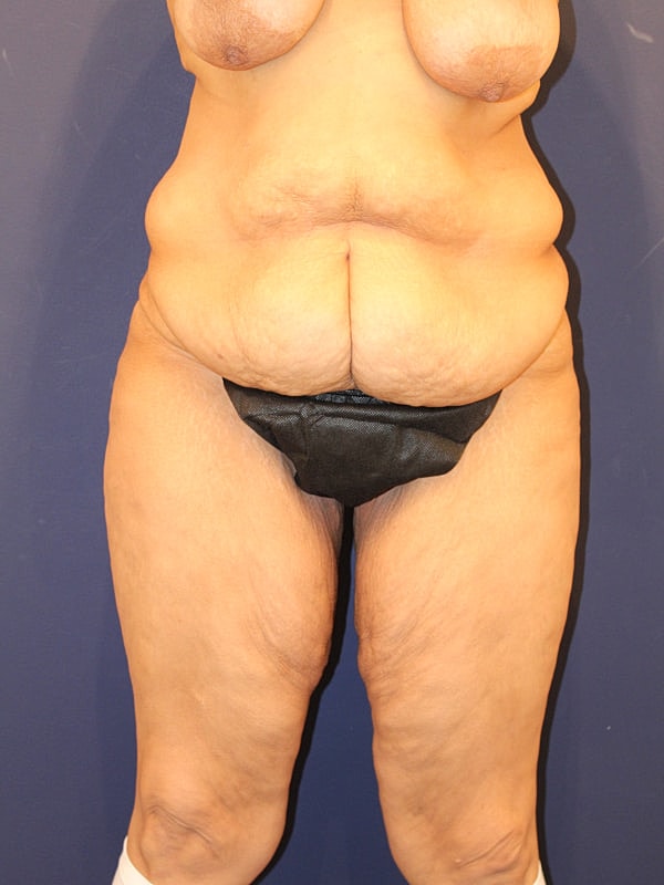 Tummy Tuck Gallery Before & After