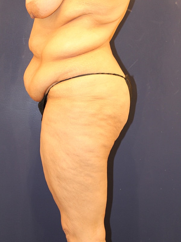 Tummy Tuck Gallery Before & After