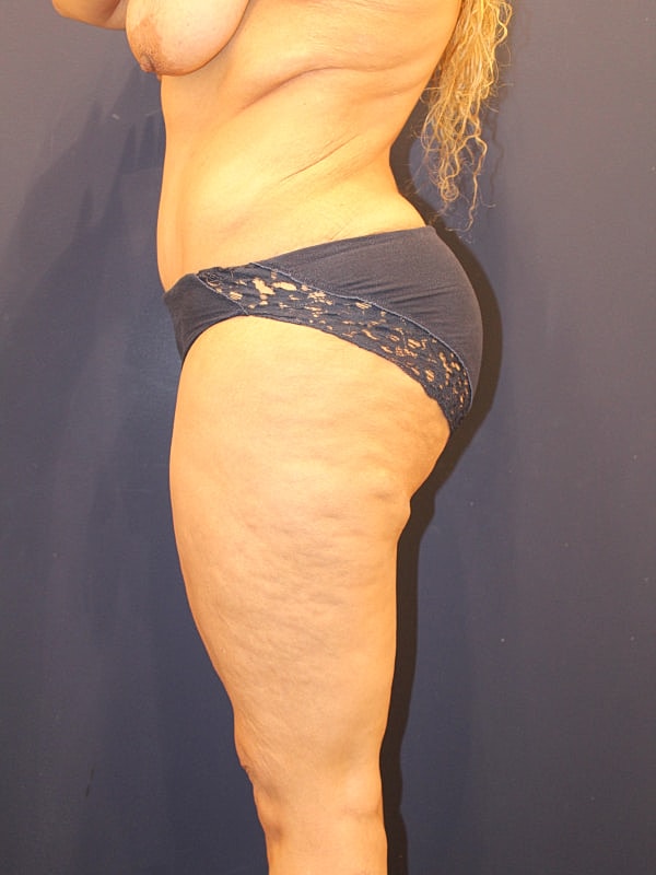 Tummy Tuck Gallery Before & After