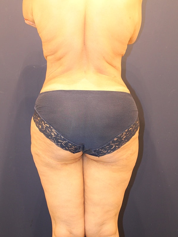 Tummy Tuck Gallery Before & After
