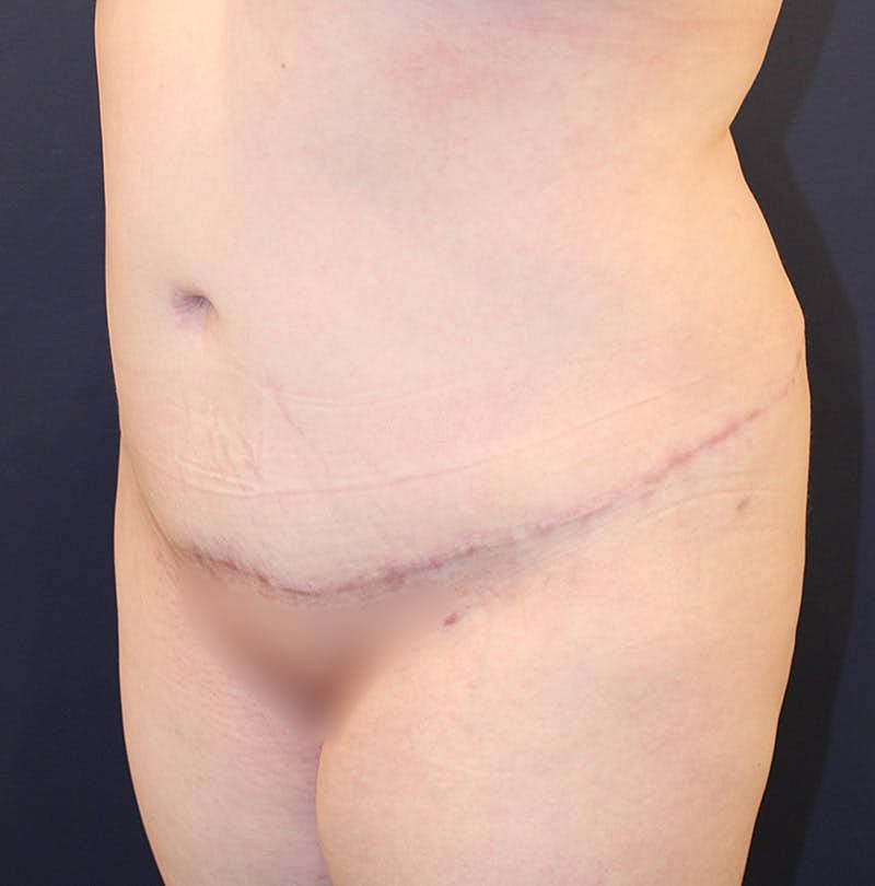 Tummy Tuck Before & After