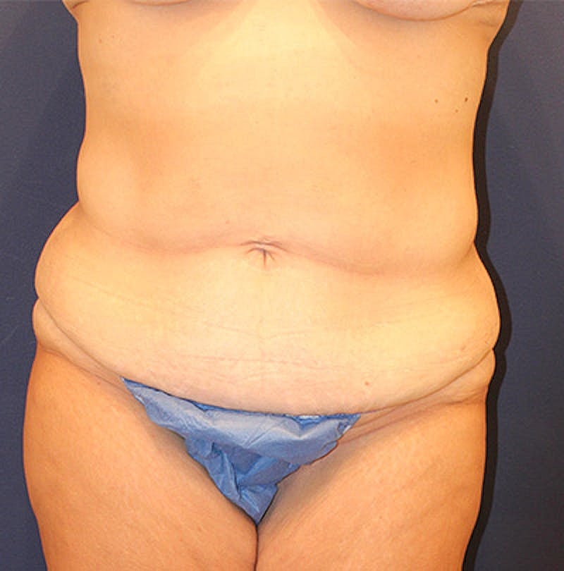 Tummy Tuck Before & After