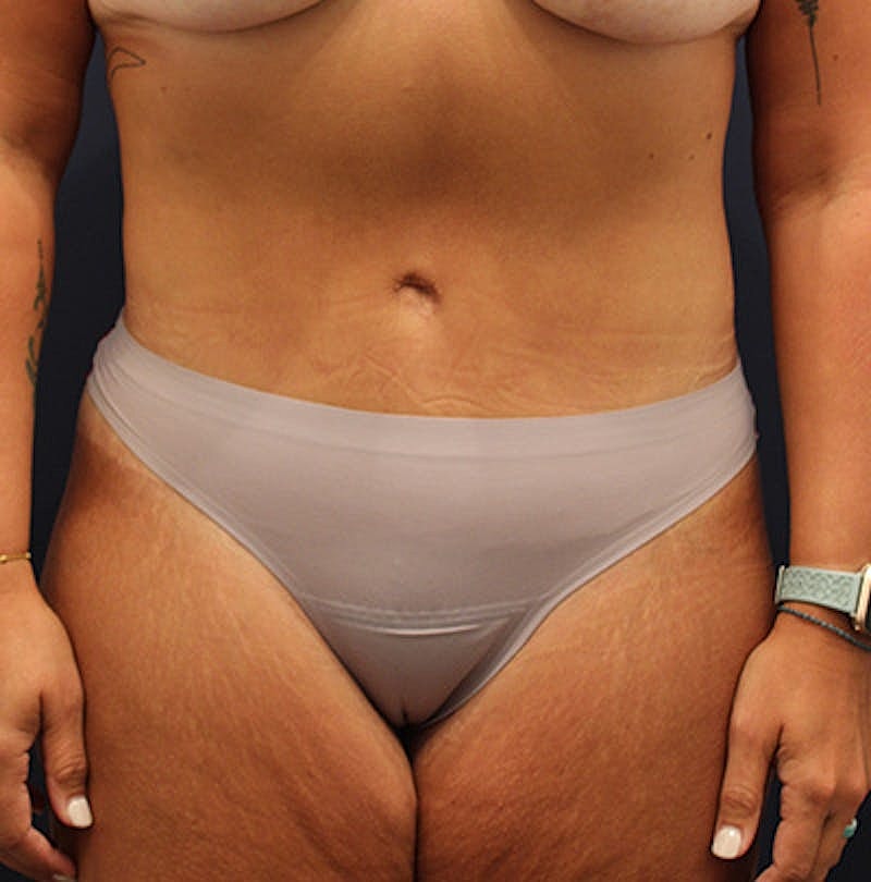 Tummy Tuck Before & After