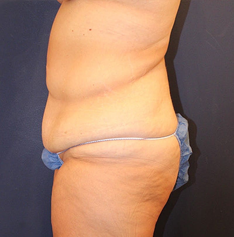 Tummy Tuck Before & After