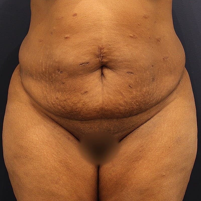 Tummy Tuck Before & After