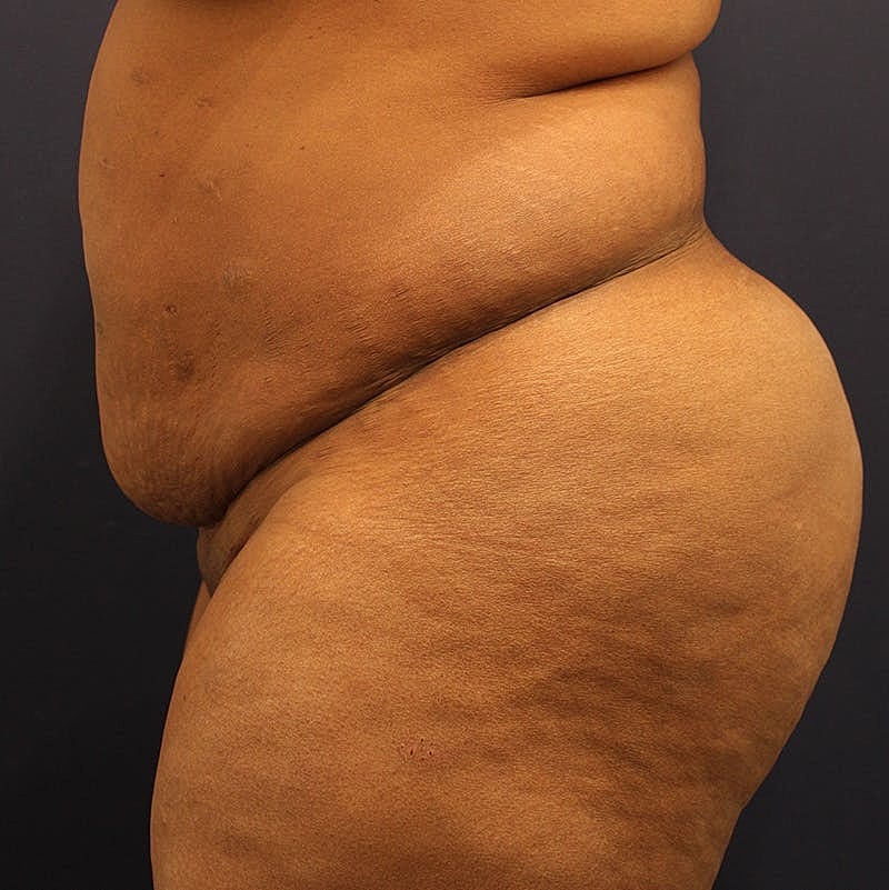 Tummy Tuck Before & After