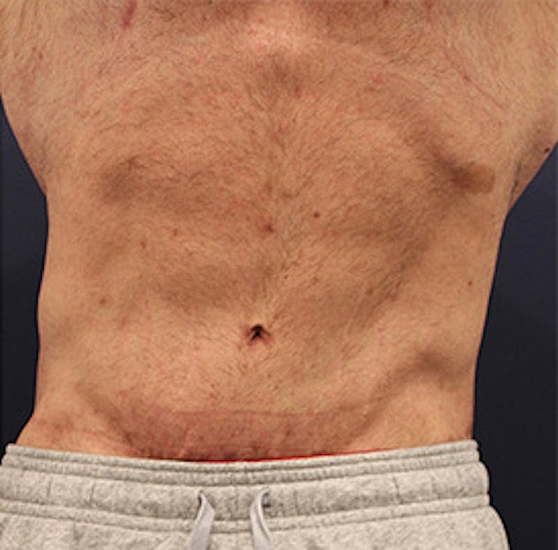Tummy Tuck Before & After
