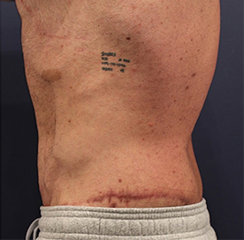 Tummy Tuck Before & After