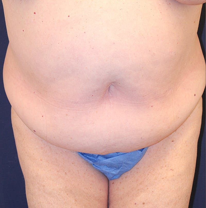 Tummy Tuck Before & After