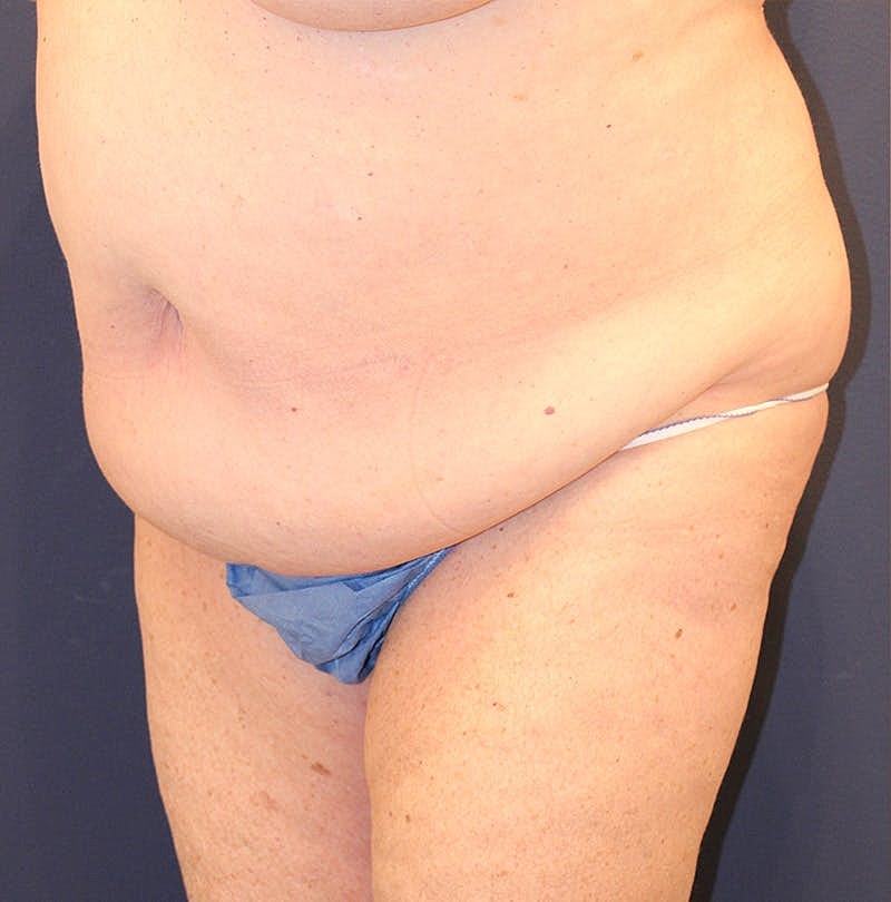 Tummy Tuck Before & After