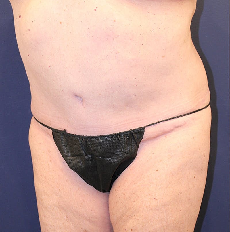 Tummy Tuck Before & After