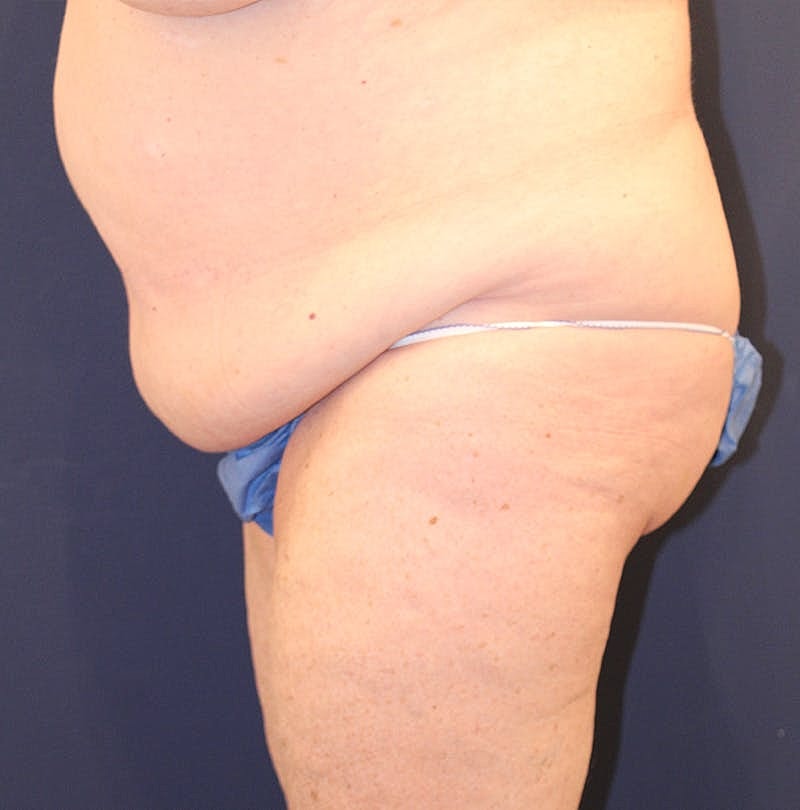 Tummy Tuck Before & After
